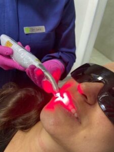 laser dente do siso botucatu