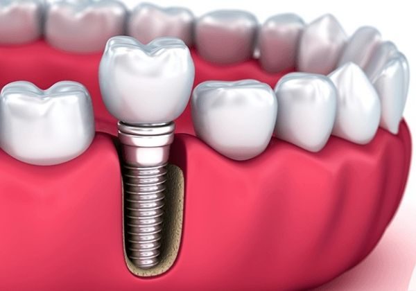 implante dentário botucatu