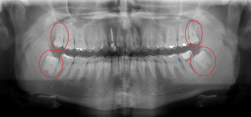 radiografia-panoramica-dente-siso-botucatu