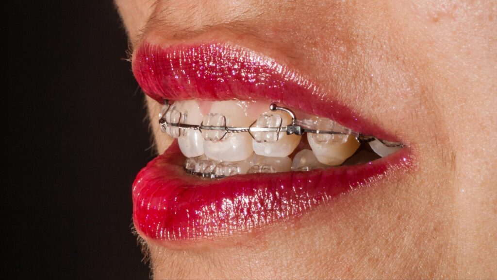 aparelho dentario ortodontico estetico safira porcelana fixo botucatu