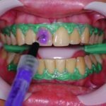 clareamento dental consultorio botucatu