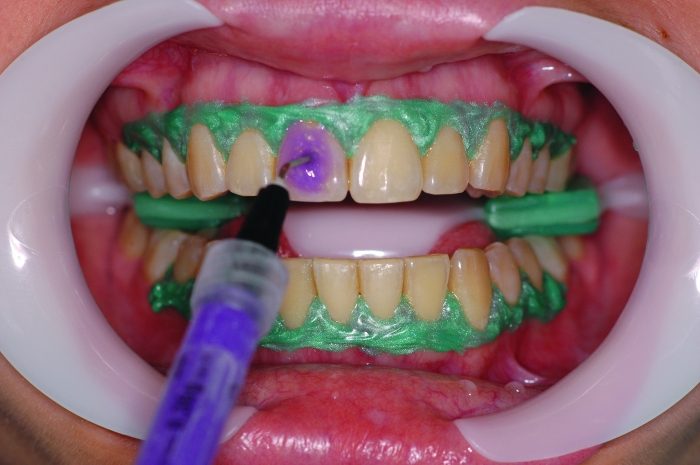 clareamento dental consultorio botucatu