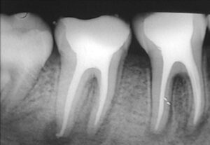 endodontia botucatu