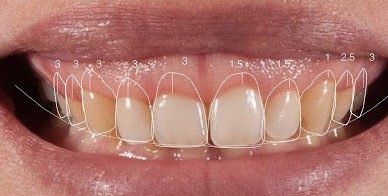 gengivoplastia