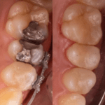 trocar obturação escura preta por resina em botucatu