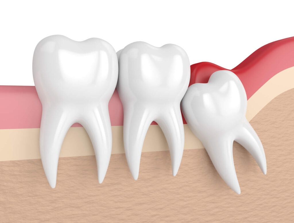 etrair dente do siso botucatu