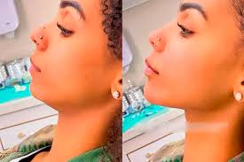 preenchimento mandibular antes e depois