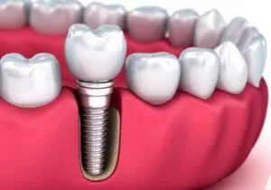 Implante Dentário Imediato